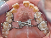 Üst Çene Genişletme Ameliyatı Riskleri ve Sonrası Üst Çene Genişletme Ameliyatı Riskleri ve Sonrası