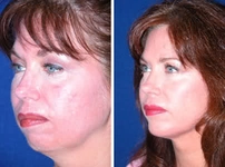 Üst Çene Geriliği Belirtileri ve Tedavisi Üst Çene Geriliği Belirtileri ve Tedavisi