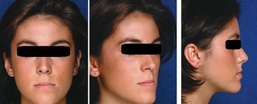 Alt Çene Önde Belirtileri ve Tedavisi Alt Çene Önde Belirtileri ve Tedavisi