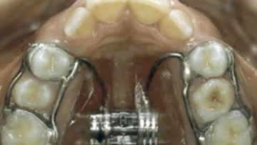 Üst Çene Genişletme Nasıl Yapılır? Üst Çene Genişletme Nasıl Yapılır?