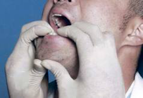 Çene Çıkığı Belirtileri ve Tedavisi