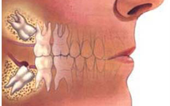 Yirmilik Diş Çene Ağrısı Belirtileri ve Tedavisi